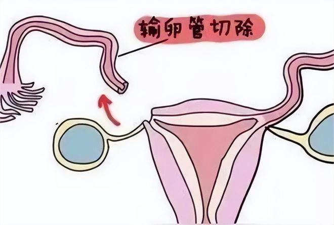 不孕不育