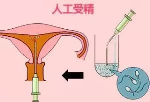 临沂试管婴儿