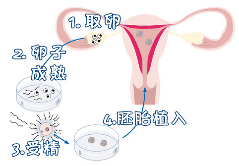 **南宁有偿捐卵**